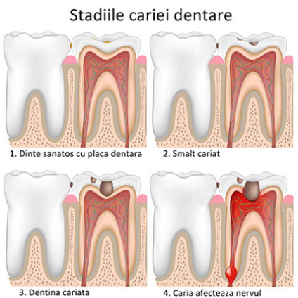 Stadiile cariei dentare